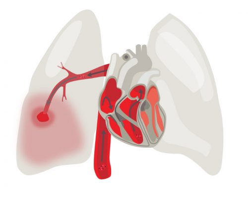 Ağciyər Arteriyasının Tromboembolizmi